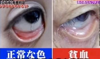 上眼皮浮腫面相|眼皮常浮腫是腎臟出問題？一分鐘從「眼睛」看出你的。